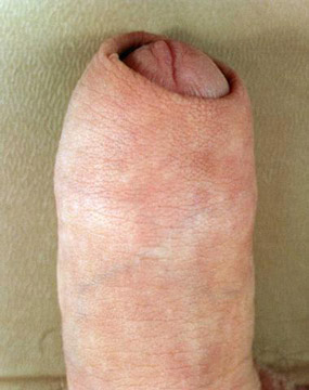 Adult Circumcision Scar 56